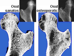 Osul: un tesut viu dinamic 3 osteoporoza, os, oase