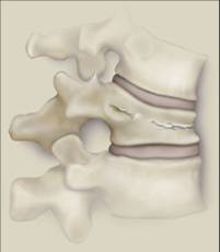 fractura vertebrala, osteoporoza, os, oase