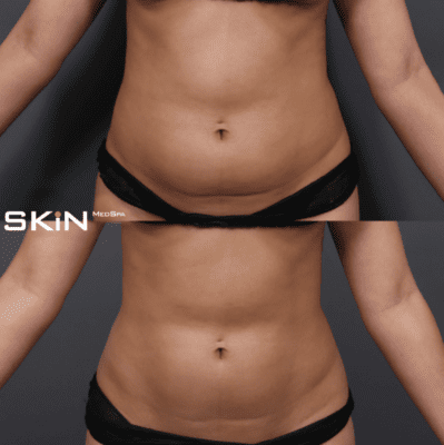 6 metode de slăbit moderne și inovative, folosind tehnici de remodelare corporală. Cum alegi cel mai eficient tratament? 7 rezultate-criolipoliza-Define-SKiN-MedSpa