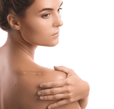 Cum poți preveni formarea unor cicatrici inestetice? 5 cum-poți-preveni-formarea-unor-cicatrici-inestetice