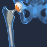 protezele-o-soluție-în-cazul-unor-afecțiuni-degenerative