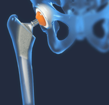 Protezele: O soluție în cazul unor afecțiuni degenerative 8 protezele-o-soluție-în-cazul-unor-afecțiuni-degenerative