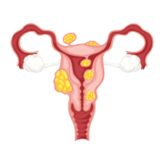 tipuri-de-fibrom-uterin-și-complicațiile-care-pot-apărea