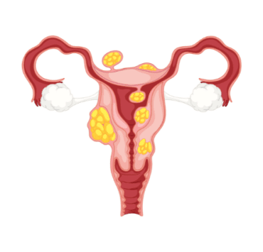 Tipuri de fibrom uterin și complicațiile care pot apărea 10 tipuri-de-fibrom-uterin-și-complicațiile-care-pot-apărea
