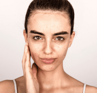 Mai mult de 85% dintre adolescenți suferă de acnee 7 mai-mult-de-85-dintre-adolescenți-suferă-de-acnee