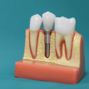 Implantul dentar - un zâmbet strălucitor şi o dantură sănătoasă!