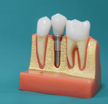 Implantul dentar - un zâmbet strălucitor şi o dantură sănătoasă! 10 Implantul dentar - un zâmbet strălucitor şi o dantură sănătoasă!