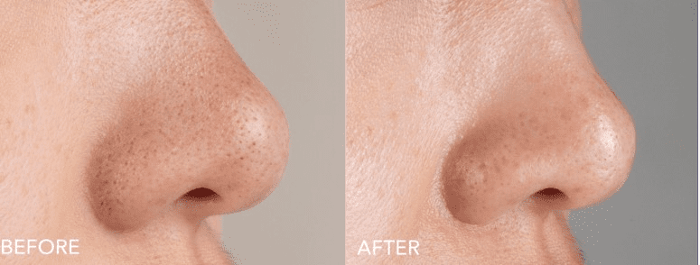 FOREO: noua mască de față KIWI™ Active Pore & Black Head Mask 5 Screenshot 37