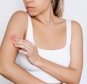 Psoriazisul în sezonul rece. Ce se întâmplă și ce remedii există? 8 psoriazis