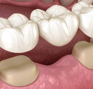 Cum sa ai grija zilnic in mod corect de o punte dentara
