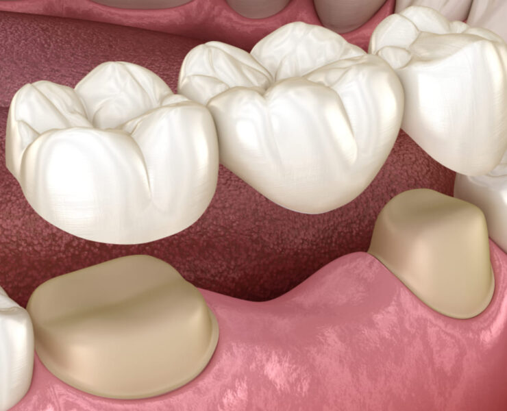 Cum sa ai grija zilnic in mod corect de o punte dentara