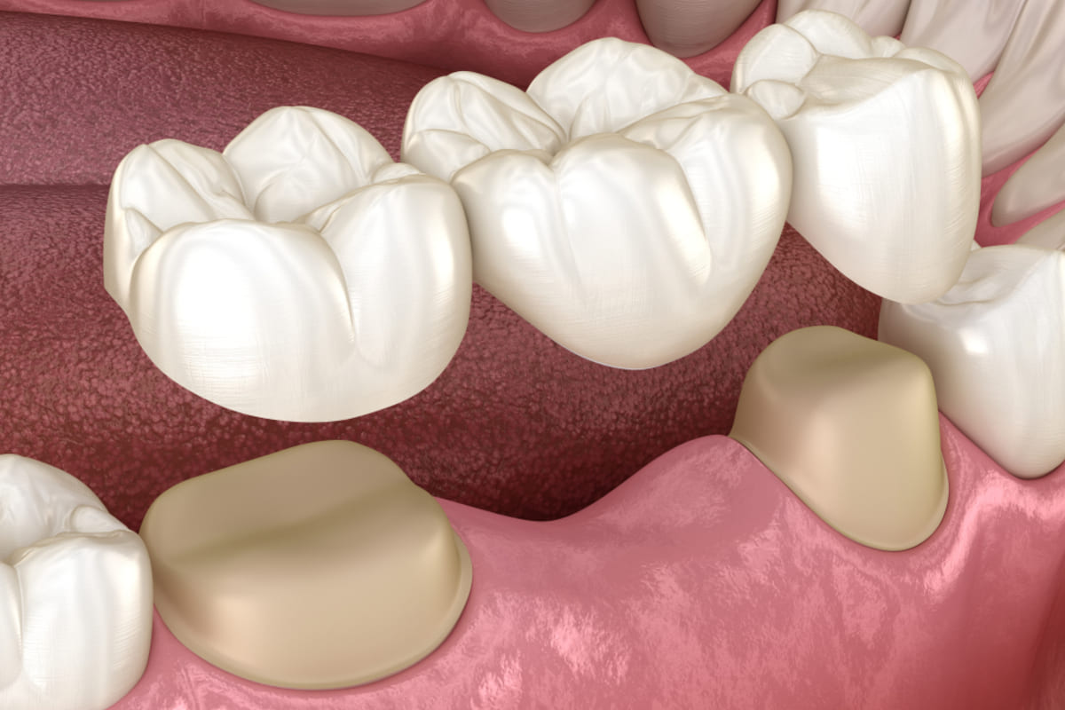 Cum să ai grijă zilnic în mod corect de o punte dentară? 1 Cum sa ai grija zilnic in mod corect de o punte dentara
