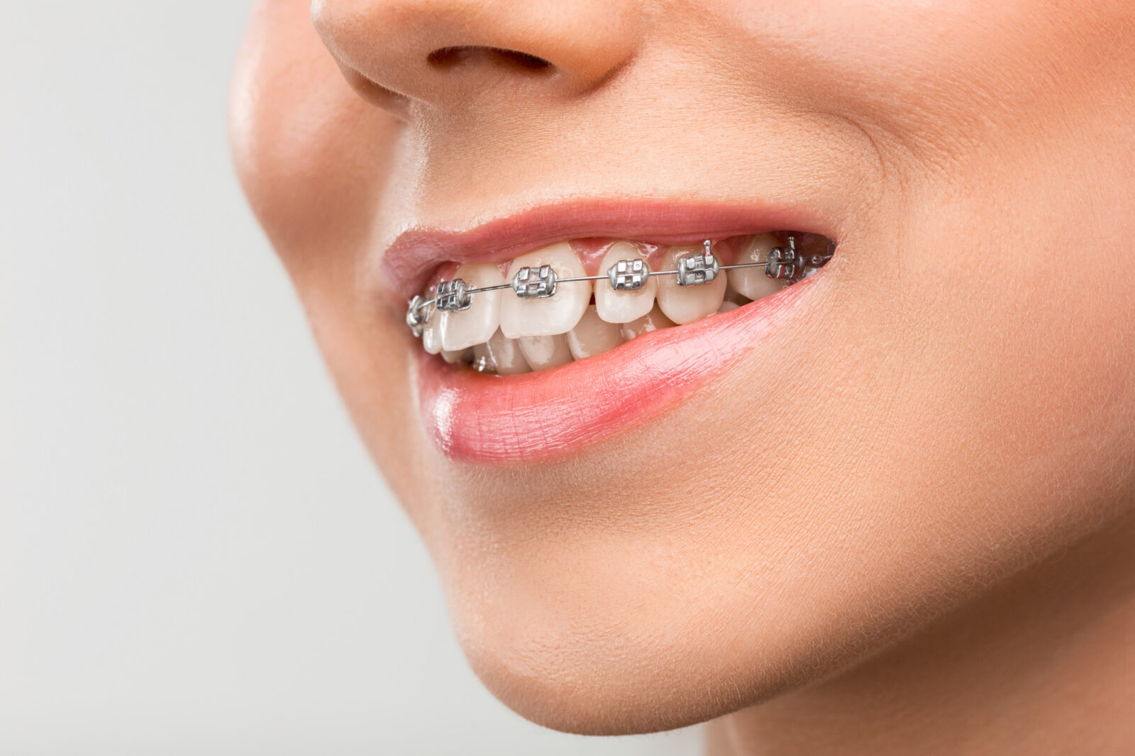 Cât de mult contează planul de afaceri pentru o clinică stomatologică 1 beautiful young woman with teeth braces