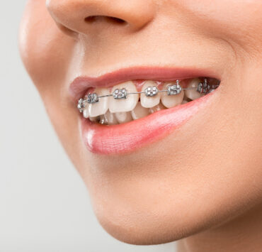 beautiful young woman with teeth braces