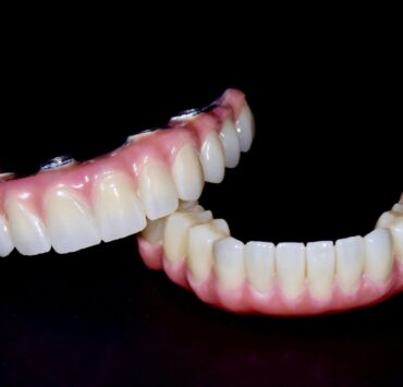 Alimentația după un implant dentar: ce alimente ajută la o vindecare rapidă