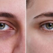 Cearcănele și stima de sine: când te ajută tratamentul cu acid hialuronic?