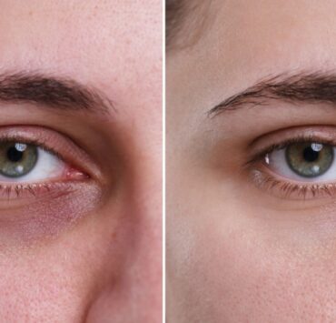 Cearcănele și stima de sine: când te ajută tratamentul cu acid hialuronic?